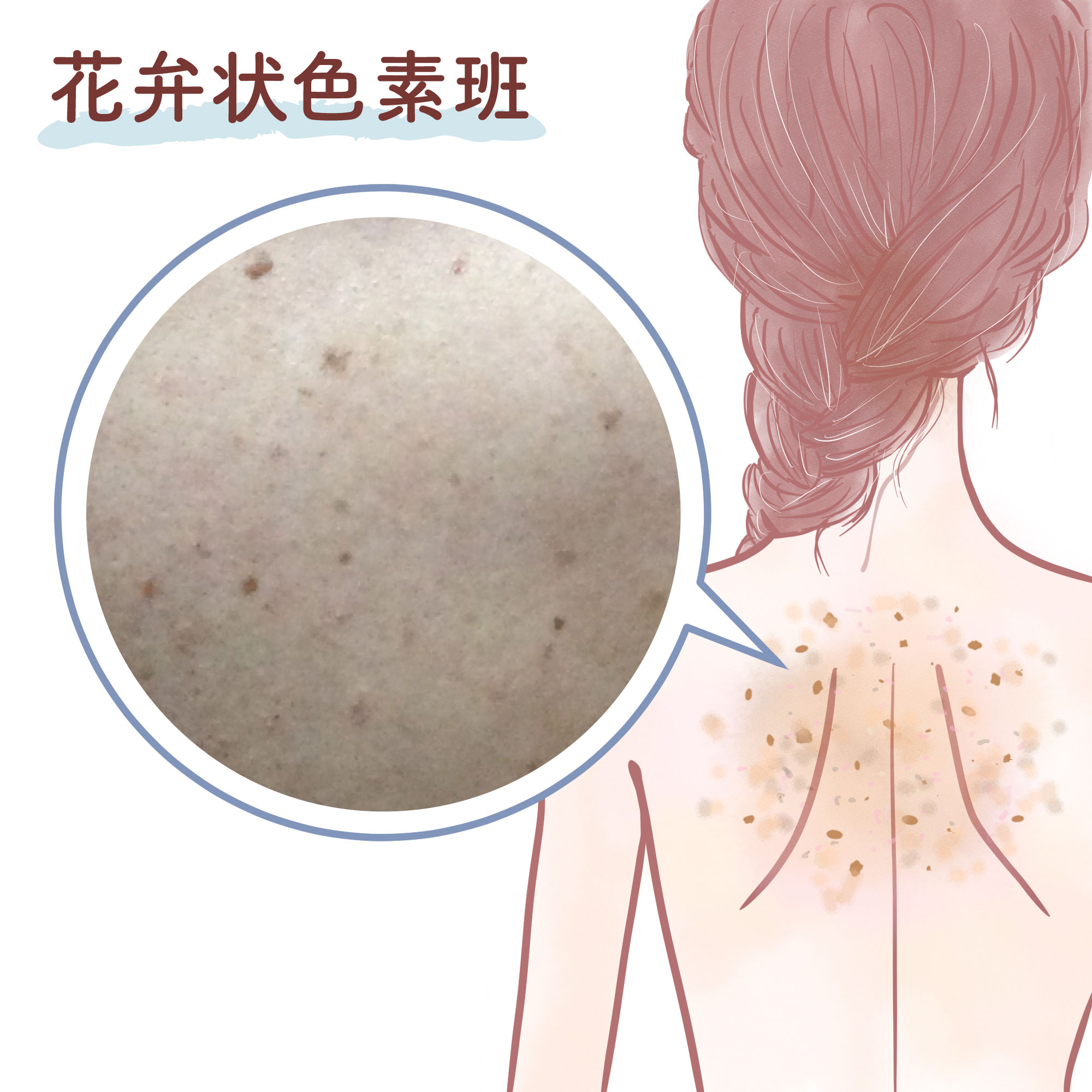 花弁状色素斑