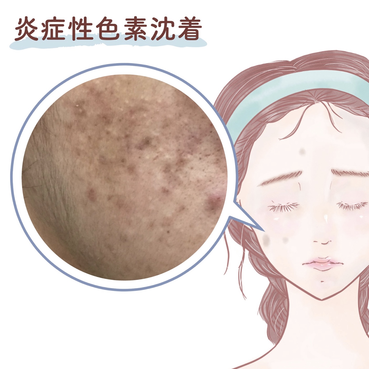 炎症性色素沈着
